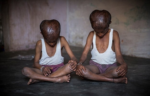 印度两兄弟身患怪病模样异于常人不敢出门