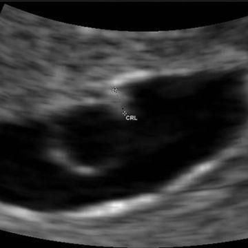 怀孕早期:孕期1-7周胎儿发育全过程,第7周时像
