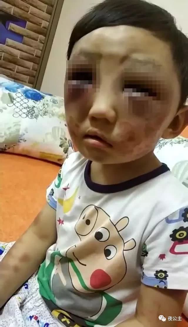 4岁男童常遭离婚妈妈毒打,逃出家求救!母亲称