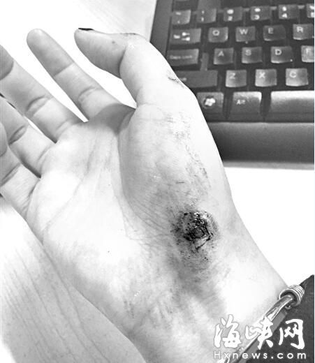 女乘客手掌擦伤(当事人供图)