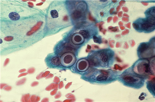 和患有幽门螺杆菌的人一起吃饭,会不会被传染