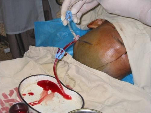 指甲上有这个标记,暗示脑出血要来了,赶紧去