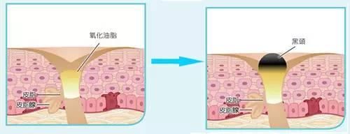郑爽贴痘痘贴录制节目?范冰冰祛痘妙招?痘痘
