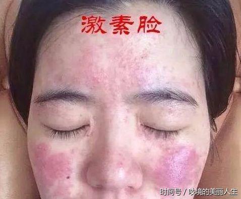 脸上发红发烫发红斑,你只是过敏还是敏感肌?一