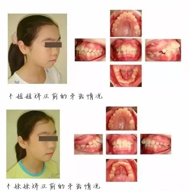 拔牙矫正VS不拔牙矫正,简直天壤之别!