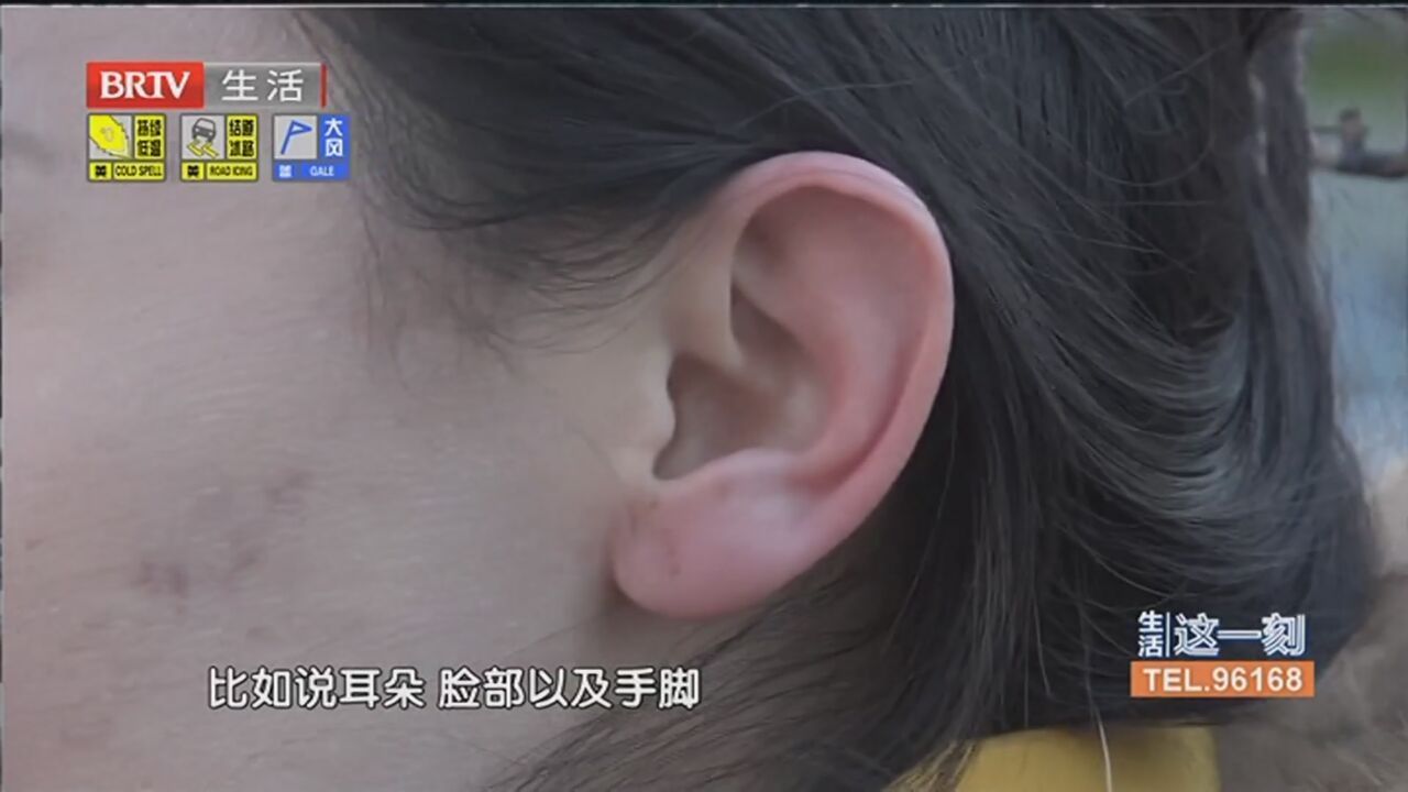 手和耳朵被冻红肿 能用“雪搓”吗?专家提示:冻伤后如何紧急处理?_北京时间