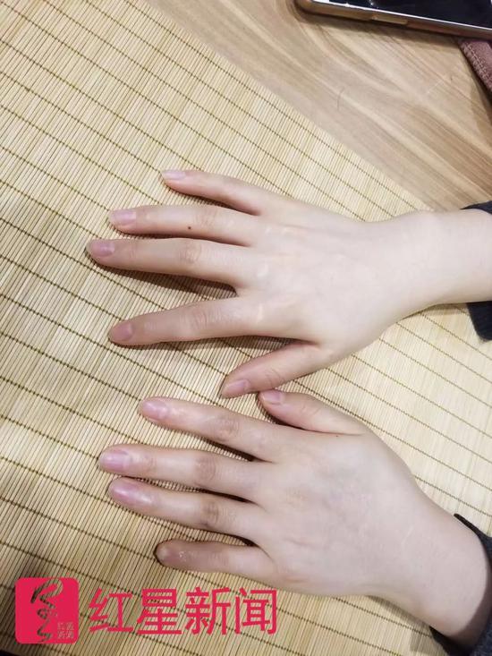 任欣(化名)变形的左手小指   图片来源:红星新闻