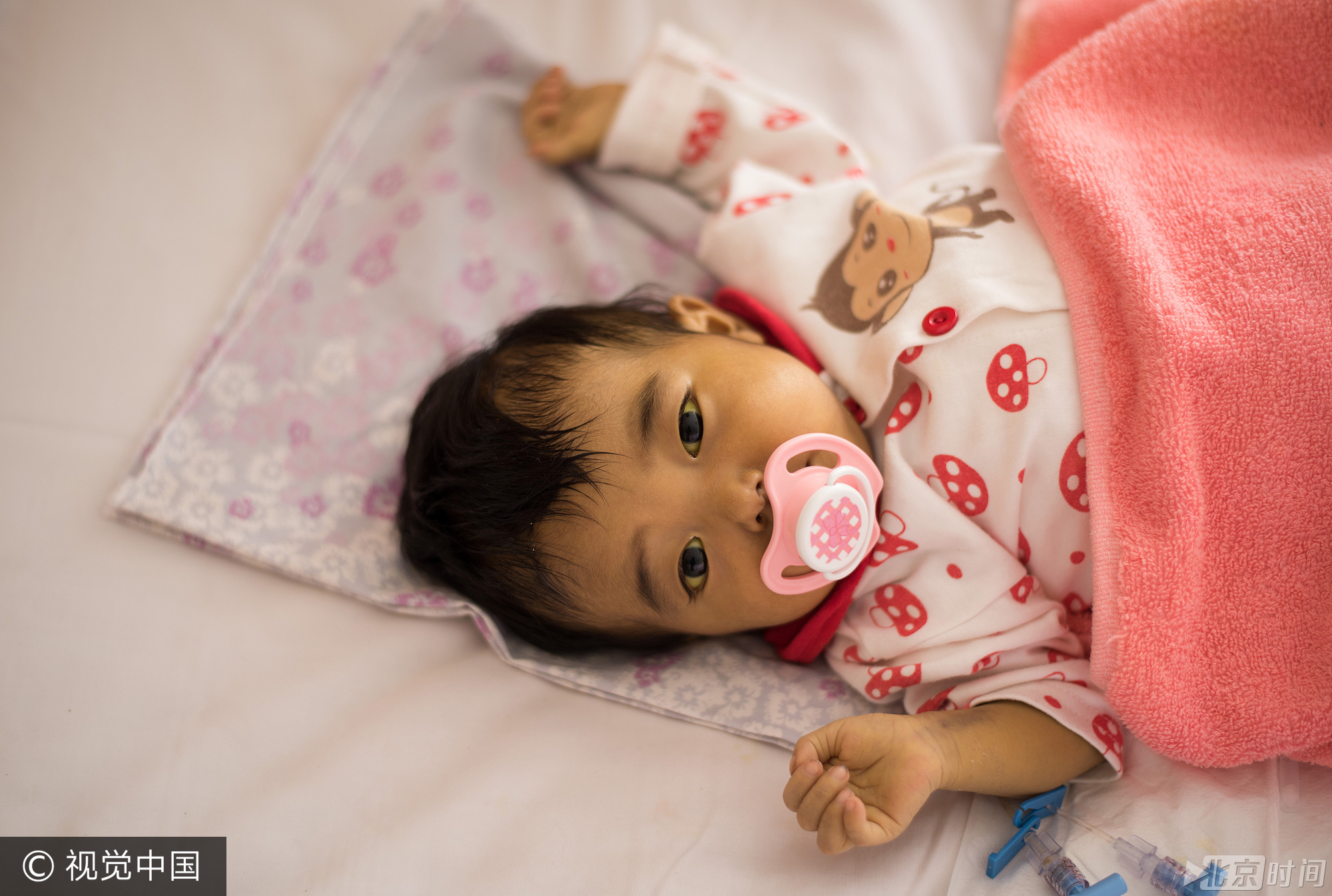 先天性胆道闭锁是危及患儿生命的一种严重疾病，由于一系列的因素导致新生儿胆道发育欠完善，从而导致胆汁不能顺利地排出体外，引起诸如黄疸、肝脏大小改变。早期手术是治疗先天性胆道闭锁的唯一手段。但不少先天性胆道闭锁新生儿或婴儿，因延误失去了治疗的最佳时机。