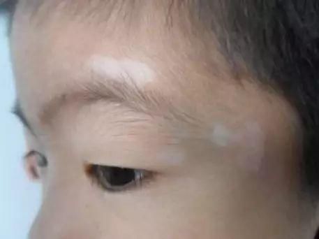 这5个症状,表明宝宝肚子里有蛔虫了,嚼它可以