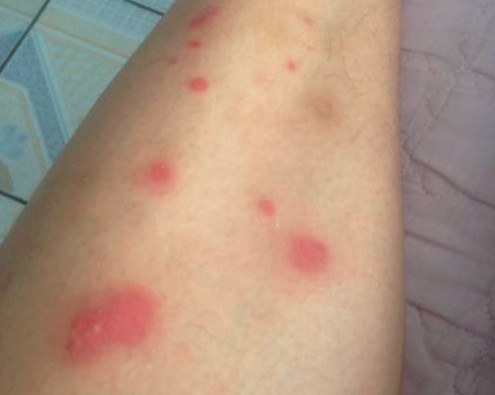 皮疹是怎么引起的?这么多原因你知道几个呢