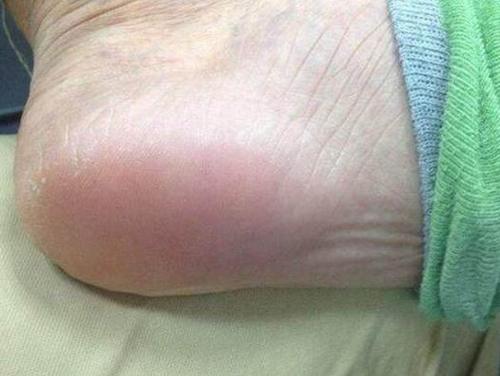 双脚一旦出现这4个症状,要警惕了,癌细胞可能