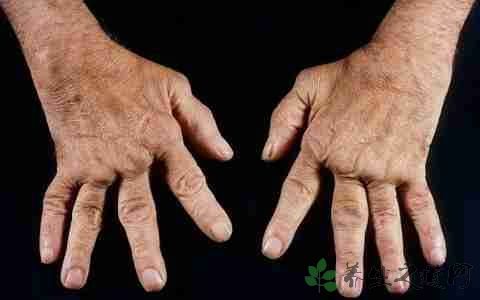 急性风湿热的发病年龄