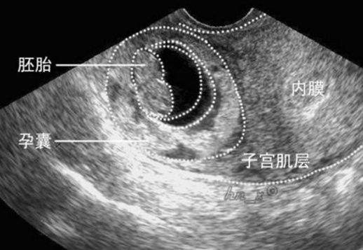 椭圆形孕囊图片图片