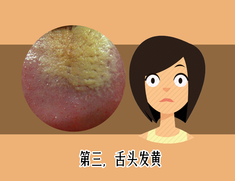 舌苔发红发黑是疾病警告?医生教你如何从舌头