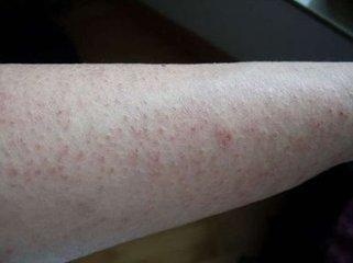 治疗干性湿疹不麻烦 保湿+止痒即可痊愈