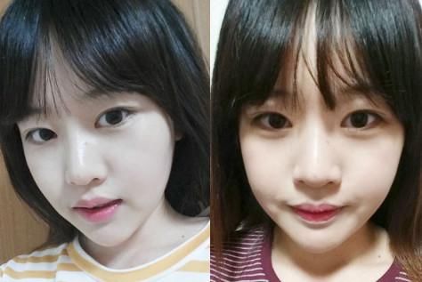 术前求美者轮廓较宽,下巴较短,因此导致面部五官给人感觉挤在一起,看