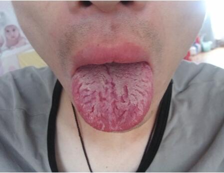 舌头裂口是否能治疗 如何从舌头看健康 舌头裂口是否能治疗 如何从舌头看健康