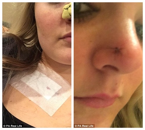 美女子13岁开始频繁晒日光浴鼻部患皮肤癌 美女子13岁开始频繁晒日光浴鼻部患皮肤癌