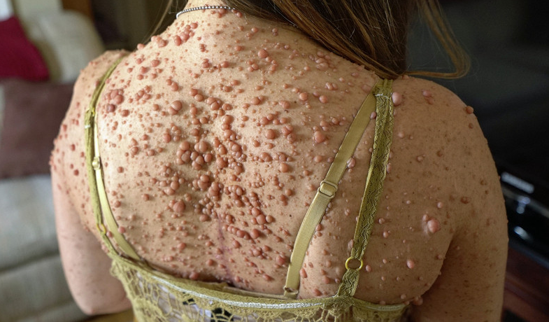 美妇女患病全身近6000个肿瘤