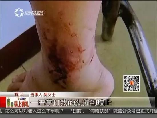 女子被三男子幽禁5小时 遭轮流殴打腿被砍断