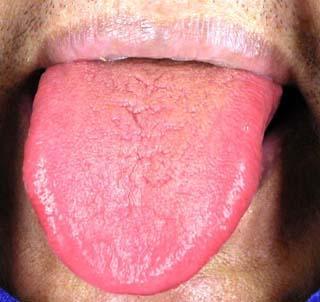 看舌头能知心脑血管疾病,一看一个准