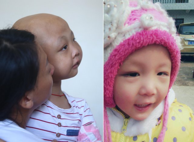 她患病面部变形 父亲剃头扇肿脸陪女儿