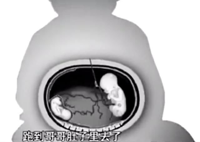 半岁的男婴儿肚子大像怀孕,去医院竟剖腹出一