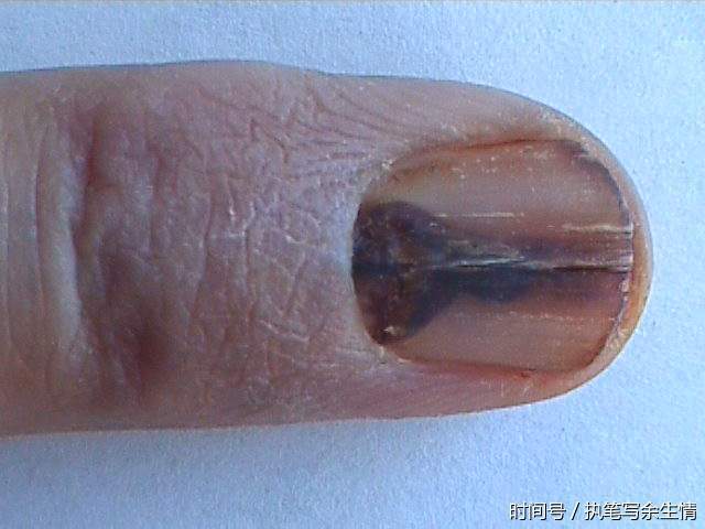 低头看下你的指甲,有没有这条黑线!小心癌症找