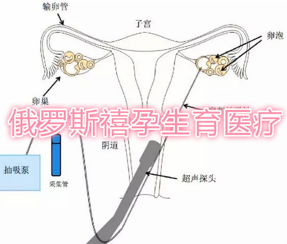 普及俄罗斯试管婴儿禧孕NGC冷冻卵子知识