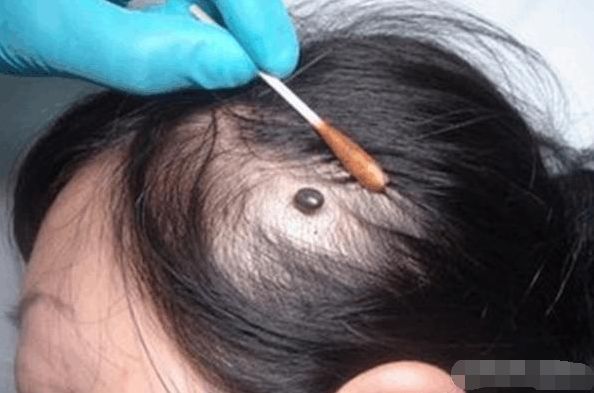 女子以为自己头上长了颗痣, 医生检查后,把女子吓坏了