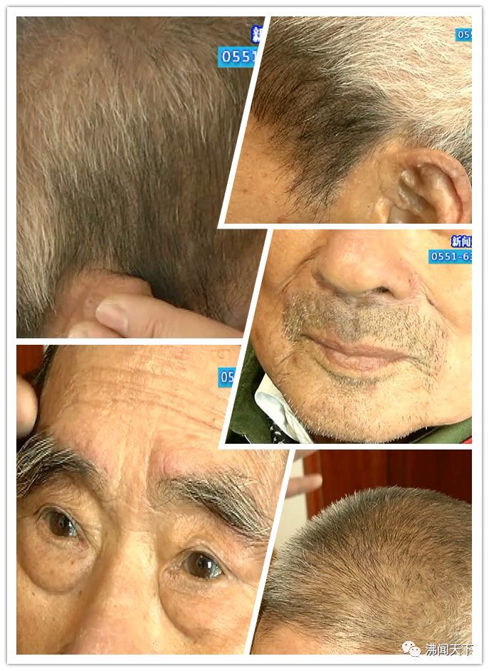 逆生长!安徽一91岁老人白发竟变黑发 家人猜测原因可能是