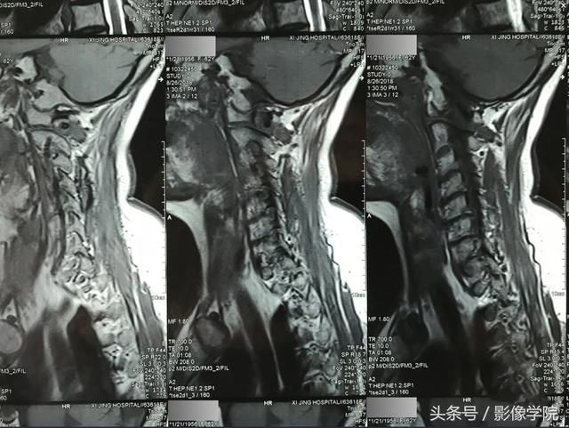 医患通用:如何翻拍X线片,CT片子的网络求医、