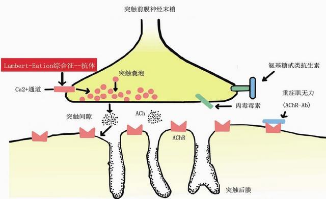 重症肌無力的中醫認識和治療