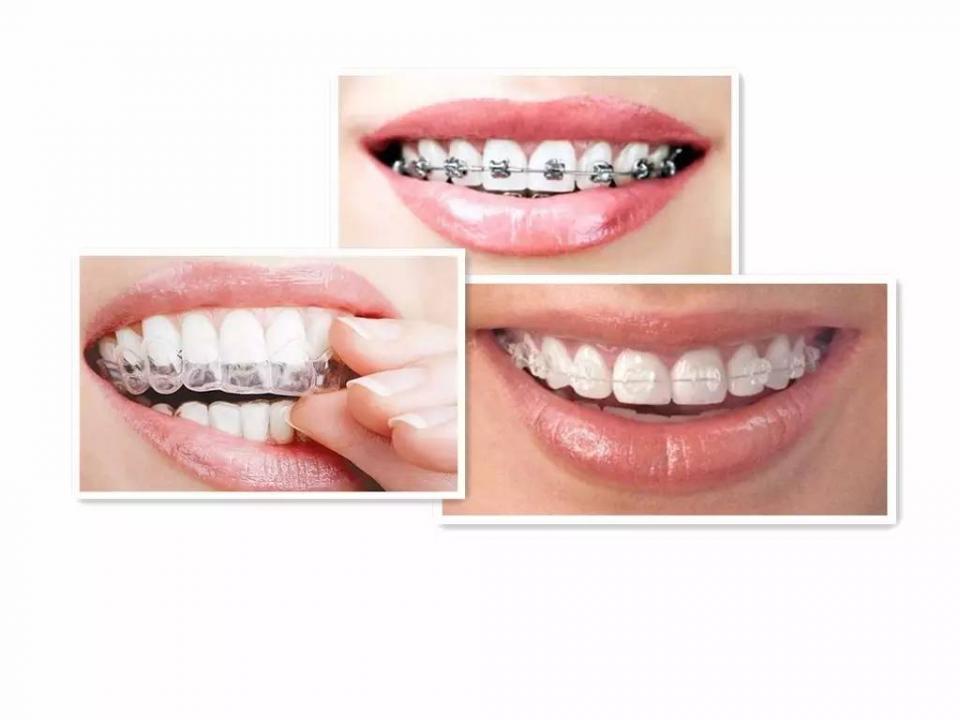 整牙日记3 ▏金属,陶瓷,隐形,哪种牙套不拔牙,见效快又不贵?