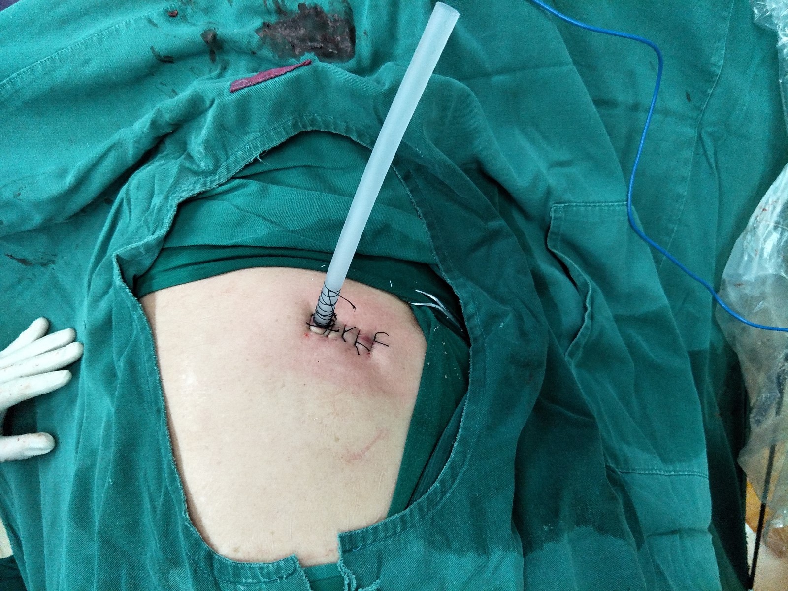 乳腺结节手术刀口图片图片
