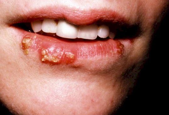 担心自己染上性病,多久之后能检查出来?