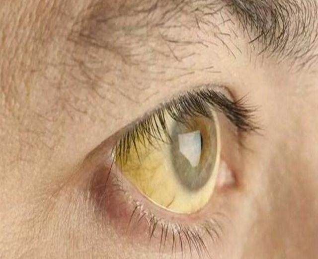 你的肝脏好不好,看这里就知道,出现这几种信号别大意,赶紧检查