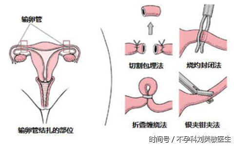 输卵管结扎复通术,找回你的二次生机!