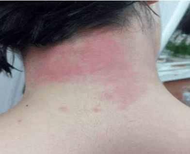 杭州一女子染头发后过敏就医,店长无回应!