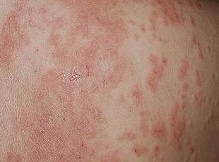 御惠堂湿疹膏治疗湿疹性皮炎效果好吗?