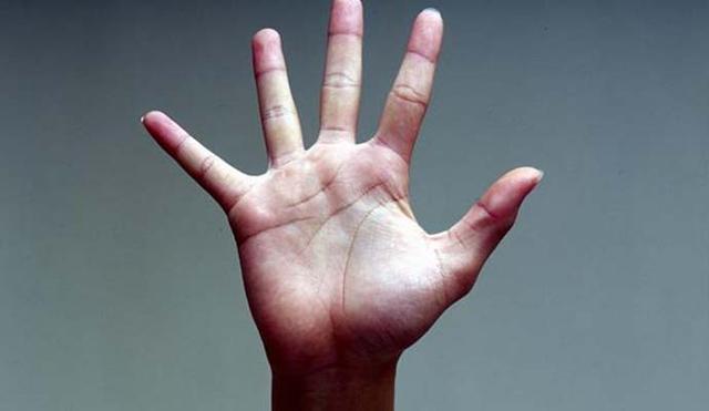 手掌充血发红,小心肝病肝掌,3种食物一吃立即