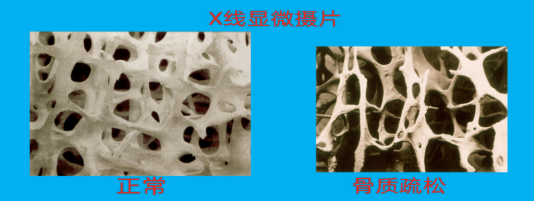 一阵咳嗽竟把肋骨咳断 医生:很多人体内缺这样东西_北京时间