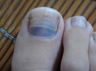 真菌性感染,教你一招,灰指甲、脚气统统赶走,有