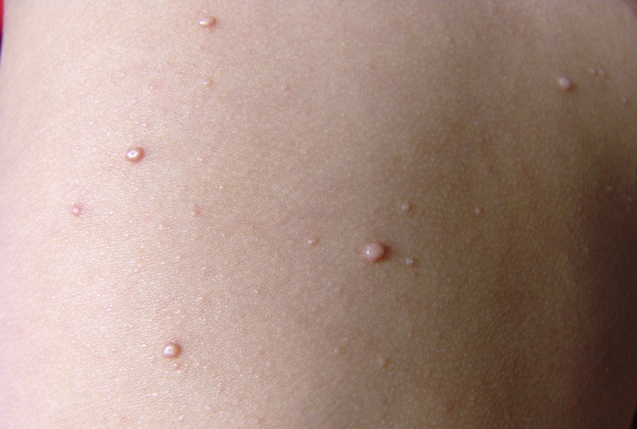 这些皮肤上的小包(软疣)需要治疗 这些皮肤上的小包(软疣)需要治疗