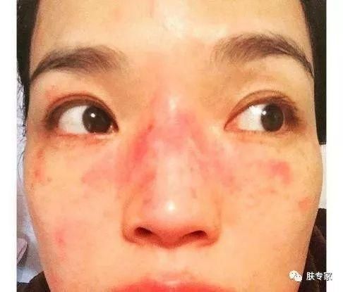 脸容易发热发痒发红?不知道如何判断自己是否