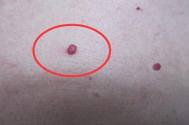 身上长小血痣别大意!可能是肝脏有毒素,排除