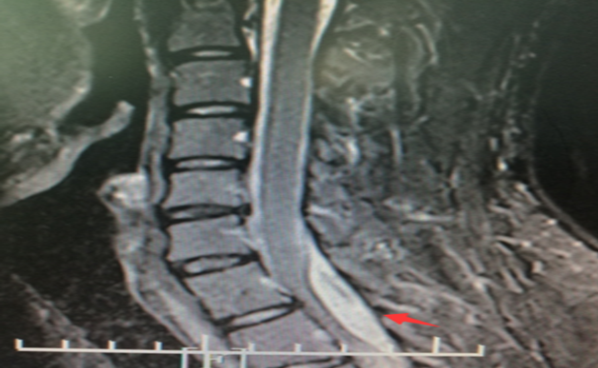 南华医院神经外科专家巧拆颅内定时炸弹
