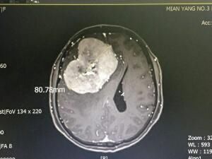 绵阳市三医院在市内率先运用血管内介入栓塞联