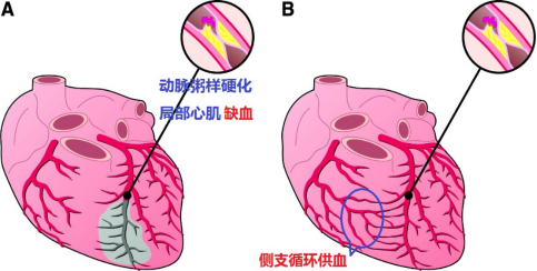 心絞痛的症狀 心絞痛的原因 秒懂心的呼救