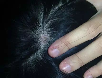 3,温和去屑,头皮不再长痘 洗发水中还添加了吡咯克酮乙醇胺盐,一种